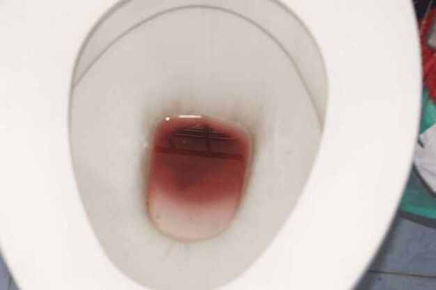 кров'яні виділення у чоловіків при збудженні